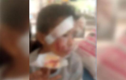 بنٹوال میں چھوٹی بچی پر آوارہ کتے کا حملہ - شدید زخمی بچی کو منگلورو اسپتال میں کیا گیا داخل